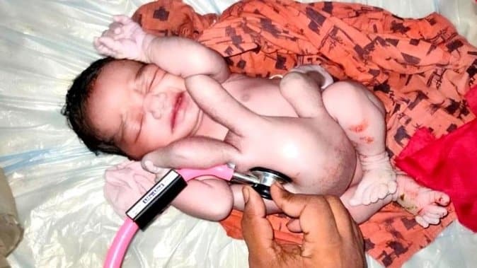 हरदोई में चार हाथ और 4 पैर वाले बच्चे का जन्म